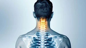 بیرون‌ زدگی دیسک گردن